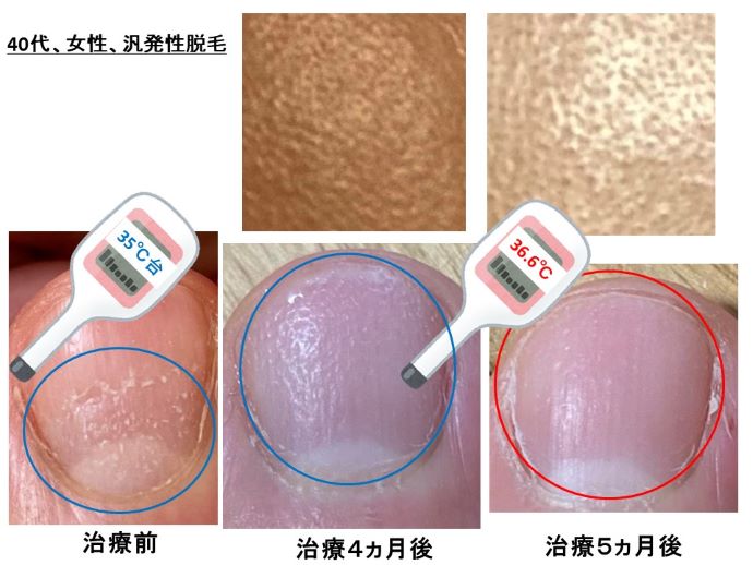 円形脱毛症　病院